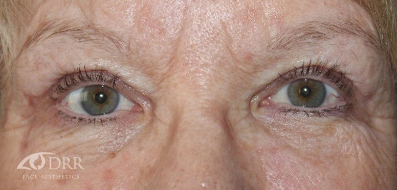 brow lift after treatment