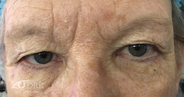 brow lift before treatment
