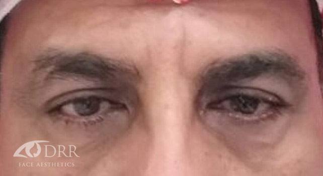 dermal fillers after treatment