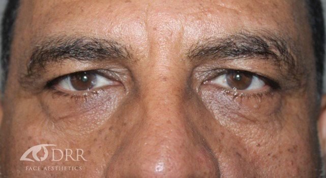 dermal fillers before treatment