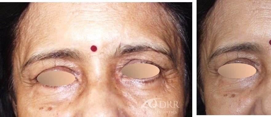 dermal fillers after treatment