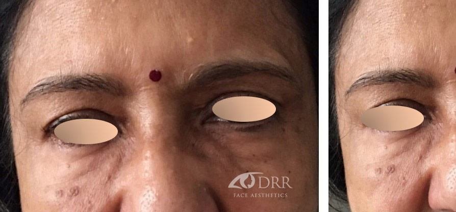 dermal fillers before treatment