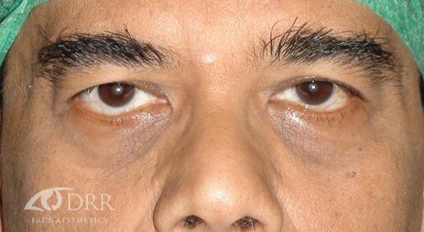 droopy brow before treatment