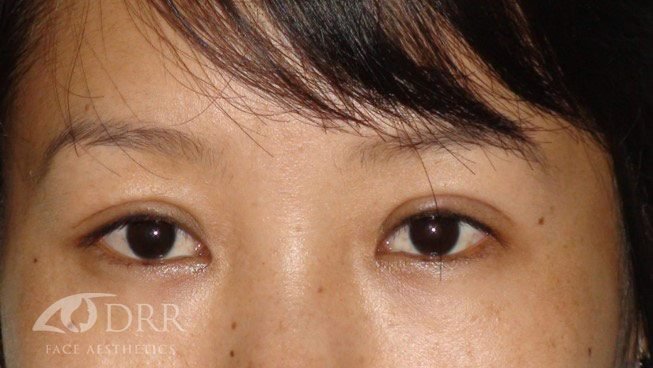 eyelid ptosis after treatment