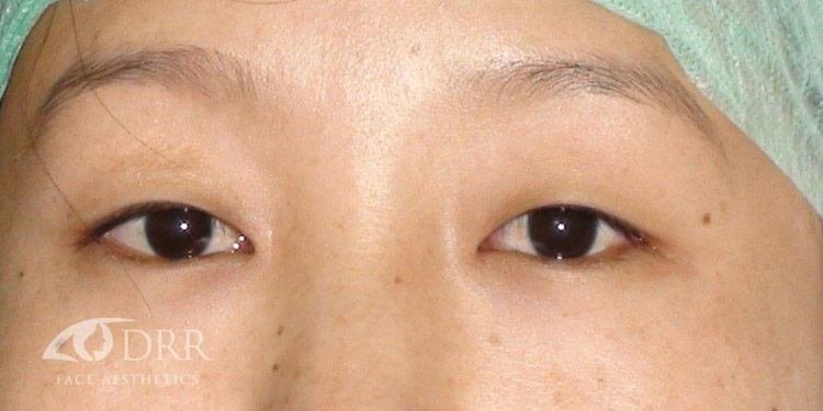 eyelid ptosis before treatment