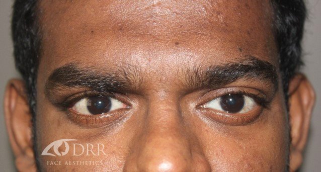 thyroid eye disease after treatment