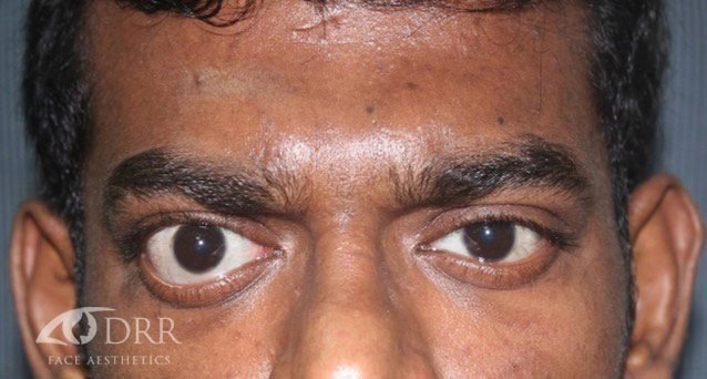 thyroid eye disease before treatment