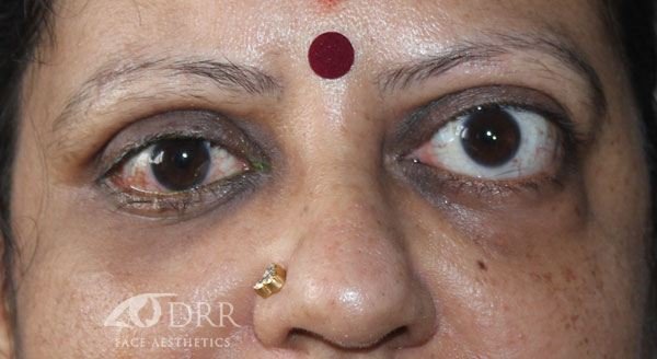 thyroid eye disease after treatment