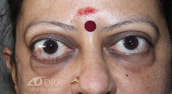 thyroid eye disease before treatment
