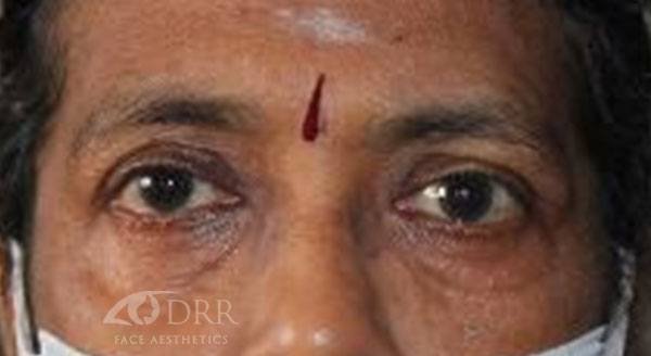 thyroid eye disease after treatment