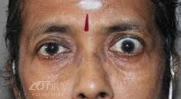thyroid eye disease before treatment