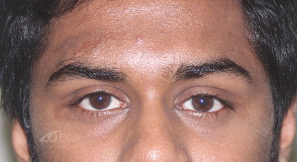 trauma after treatment