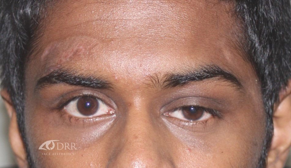 trauma before treatment