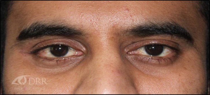 trauma after treatment