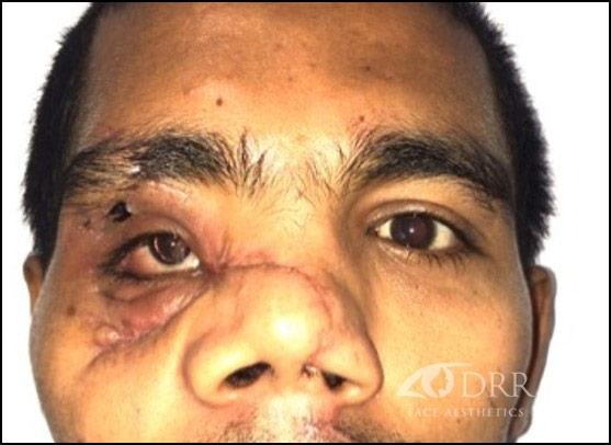 trauma before treatment