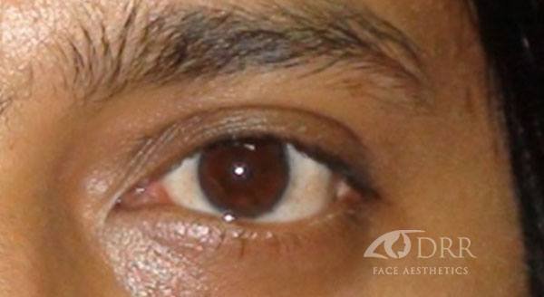 under eye bags after treatment