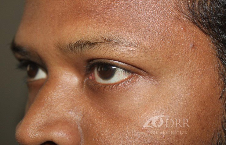 xanthelasma after treatment
