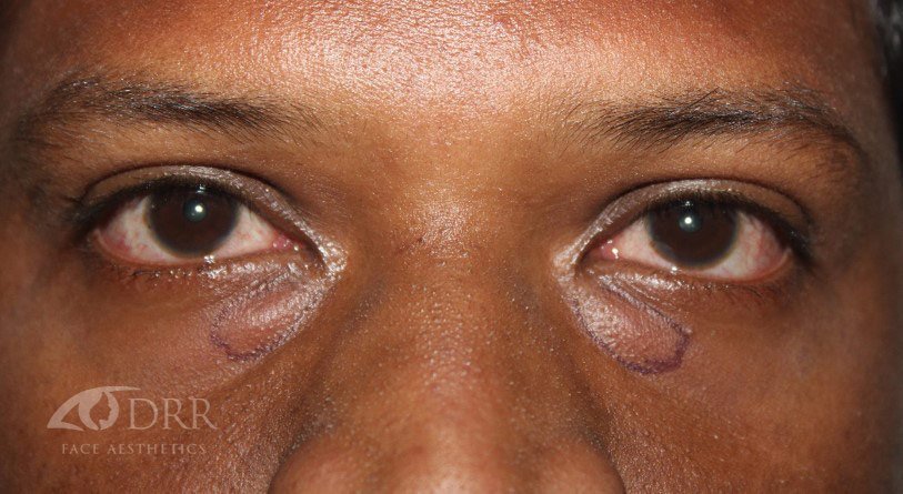 xanthelasma before treatment
