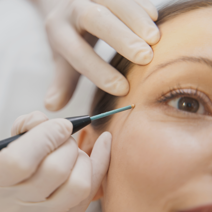 Treatment at Visage by Dr Priti, Chennai