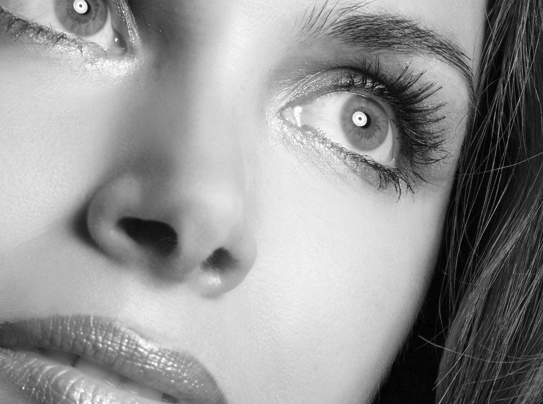Close view of the eye area affected by facial palsy